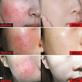 Instant Facial Redness Repair Cream Soothing Red Blood Rosacea Treatment Improve Sensitive Skin Anti Redness Skin Care Cosmetics
