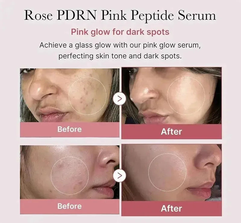 Niacinamide Dark Spot Remove Serum Face Freckle Melanin Correcting Moisturizing Brightening Anti Pigmentation Repair Skin Care