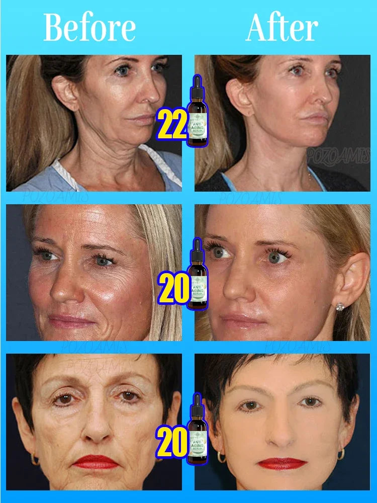 wrinkles disappeared