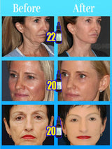 wrinkles disappeared