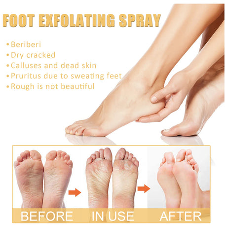 Ouhoe Foot Exfoliating Spray 72H Moisture Lock Callus Softener Anti Dry Crack Repair Odor Control Brightening Foot Care Liquid