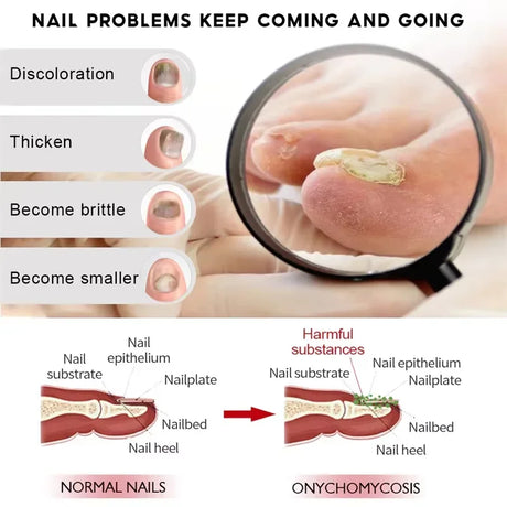 7 Days Nail Fungus Treatment Serum Ginger Anti-infective Paronychia Onychomycosis Toe Foot Nail Fungal Repair Gel Hand Foot Care