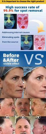 Dark Spot Remover for Face Removing Freckle Chloasma Senile Plaques Sunburn Cyasma Chorioplaque Freckle Cream