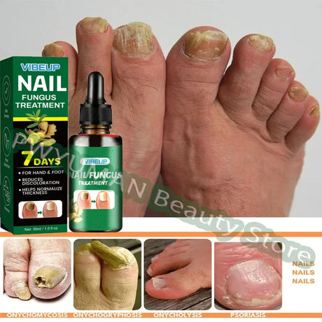 7 Days Nail Fungus Treatment Serum Ginger Anti-infective Paronychia Onychomycosis Toe Foot Nail Fungal Repair Gel Hand Foot Care