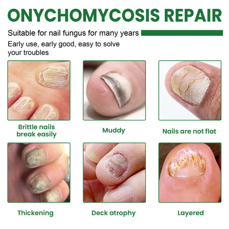 7 Days Nail Fungus Treatment Serum Ginger Anti-infective Paronychia Onychomycosis Toe Foot Nail Fungal Repair Gel Hand Foot Care