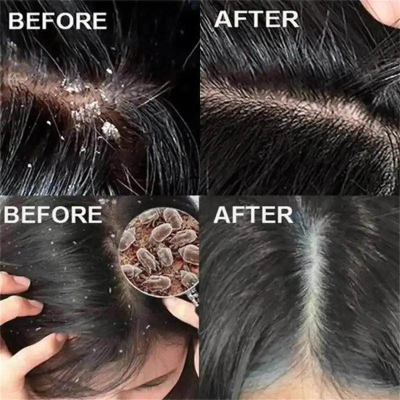 Fast Anti Exfoliating Scrub Remove Dandruff Anti Itching Treatment Seborrheic Scalp Oil Control Repair Scalp Beauty Health Care