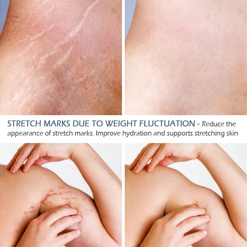 Snail Removes Stretch Mark Cream To Remove Postpartum Obesity Pregnant Women Repair Anti-Aging Anti-Winkles Firming Body Cream