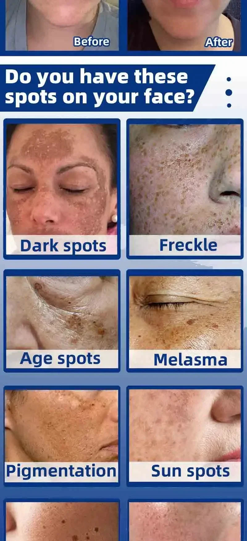 Dark Spot Remover for Face Removing Freckle Chloasma Senile Plaques Sunburn Cyasma Chorioplaque Freckle Cream