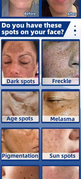 Dark Spot Remover for Face Removing Freckle Chloasma Senile Plaques Sunburn Cyasma Chorioplaque Freckle Cream