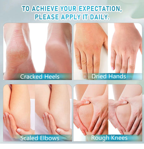 40% Urea Foot Cream Stick - Moisturizing & Exfoliating Cracked Heel Repair Deep Hydration for Dry Feet Long protect