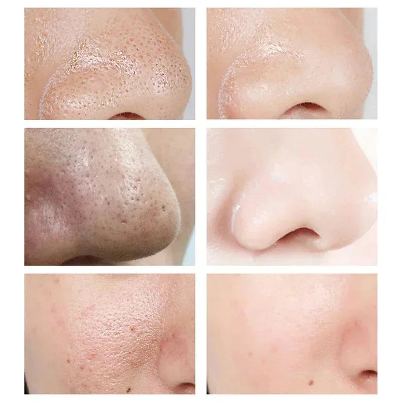 Remove Large Pores Serum Salicylic Acid Facial Pore Shrinking Tightening Pore Minimizing Firming Smooth Essence Korean Skin Care