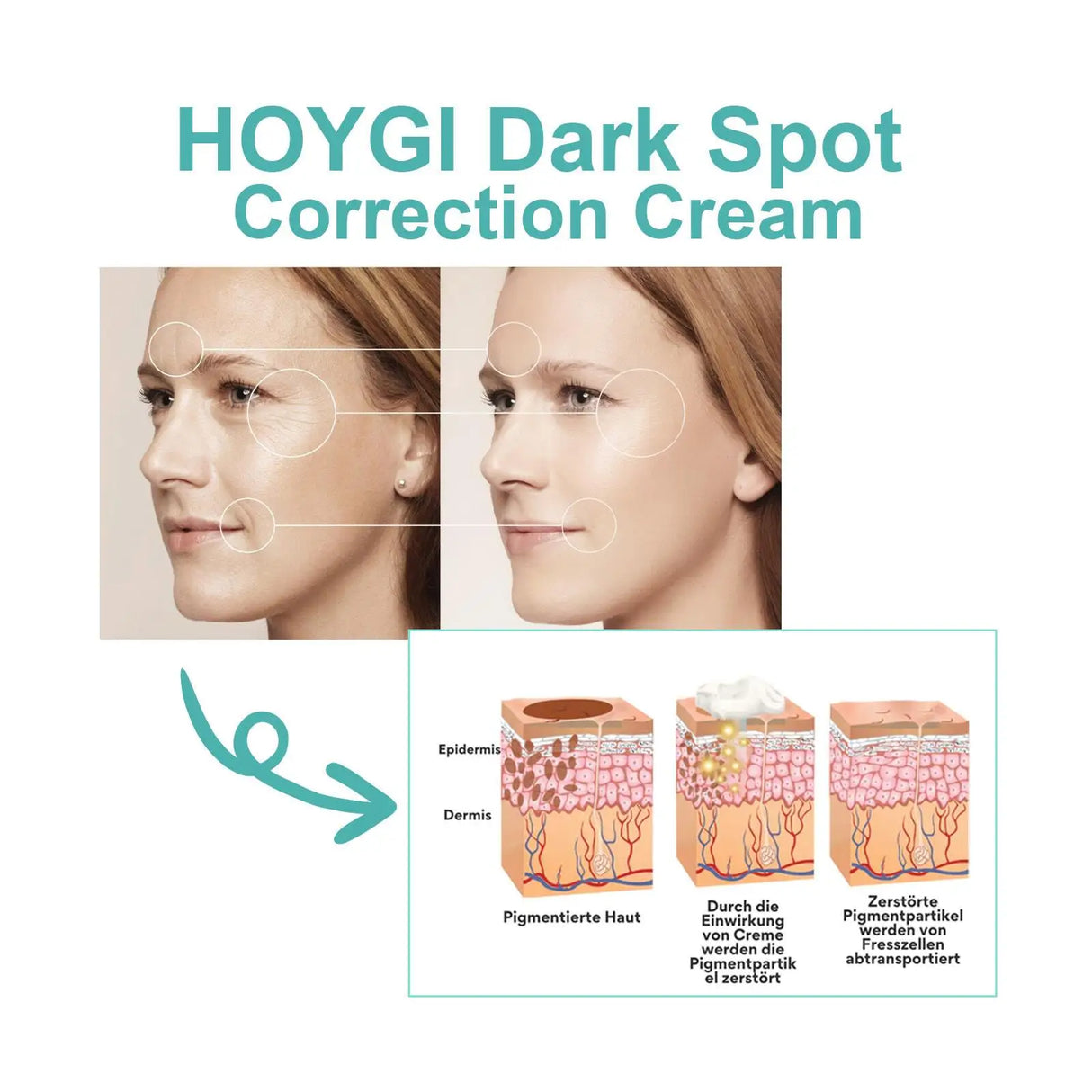 Powerful Spot-removing Whitening Freckles Cream Remove Melasma Dark Spots Fade Pigmentation Acne Moisturizing Brighten Skin Care