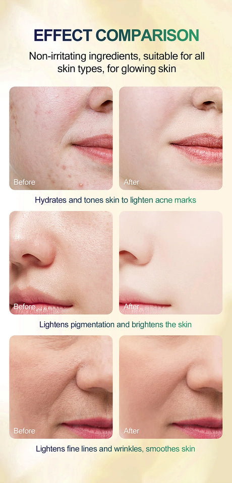 High Quality 50% Chemical Peel Acid Skin Superforce Pigmentation Lightening Melanin Acne Treatment Remove Scar