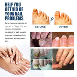 South Moon Foot Spray Anti Smell Remove Toenail Fungal Paronychia Onychomycosis Care Deodorant Antiperspirant Nail Repair Spray