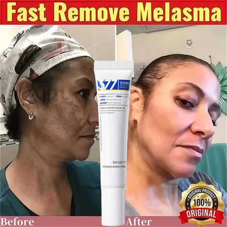 Powerful Spot-Removing Whiten Cream Brighten Skin Fast Eliminates Melanin Pigmentation Melasma Dark Spots Korean Face Skin Care
