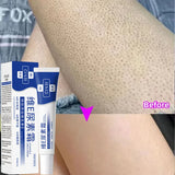 Keratosis Pilaris Repair Treatment Cream Exfoliating Removal Chicken Skin Cleaning Acne Spots Moisturizing Smooth Body Skin Care