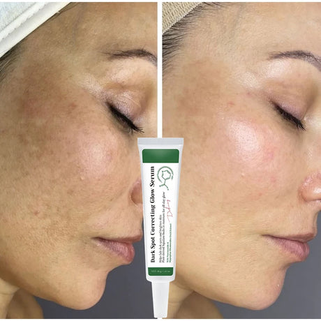 Dark Spot Correcting Glow Serum,Dullness,Acne,And Melanin Remover,Niacinamide Facial Skin Moisturizing Brightening Skincare