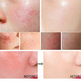 B5 Repair Facial Redness Cream Instant Spider Vein Remove Sensitive Skin Sooth Anti Redness Rosacea Treat Lotion Korean Cosmetic