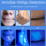 NEW Professional Dermatoscope Skin Medical Magnifier Detection Woods Lamp UVA Lamp For Vitiligo Detection