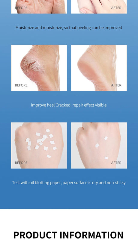 Anti Crack Foot Cream For Dry And Cracked Feet And Heels, Moisturizing Dry Feet And Heels, Preventing Your Feet From Cracking