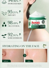 SADOER Tea Tree Acne Removing Face Cream Anti Acne Hydrating Oil Control Moisturizing Facial Creams Face Skin Care Products