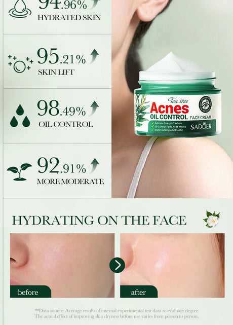 SADOER Tea Tree Acne Removing Face Cream Anti Acne Hydrating Oil Control Moisturizing Facial Creams Face Skin Care Products