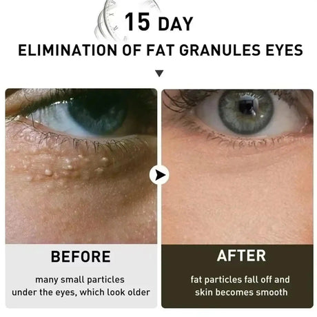Remove Eye Fat Particles Serum Milia Treatment Products Anti Puffiness Anti Inflammatory Repair Skin Barrier Korean Skin Care
