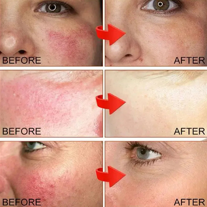 B5 Repair Facial Redness Cream Instant Spider Vein Remove Sensitive Skin Sooth Anti Redness Rosacea Treat Lotion Korean Cosmetic