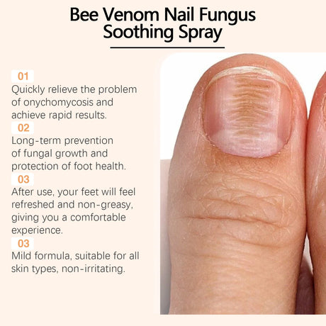 Bee Venom Nail Fungus Repair Spray Gray Nail Treatment Onychomycosis Paronychia Removal Relieve Foot Odor Hand Foot Nail Care