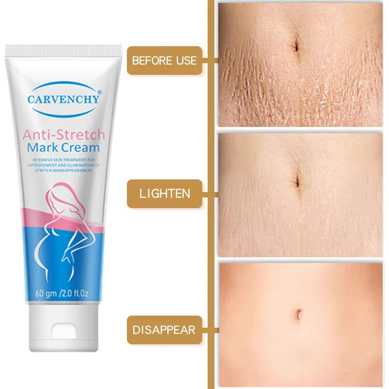 Snail Removes Stretch Mark Cream To Remove Postpartum Obesity Pregnant Women Repair Anti-Aging Anti-Winkles Firming Body Cream
