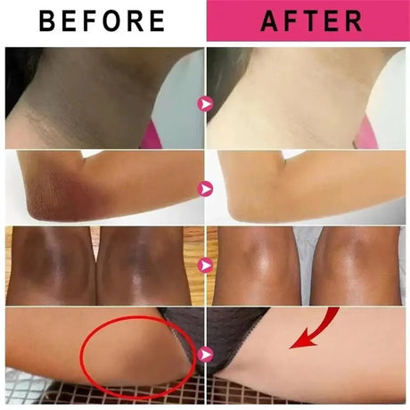 Whitening Cream For Dark Skin Underarm Bleaching Armpit Lightening And Intimate Area Woman Moisturizer Korean Skin Care Products