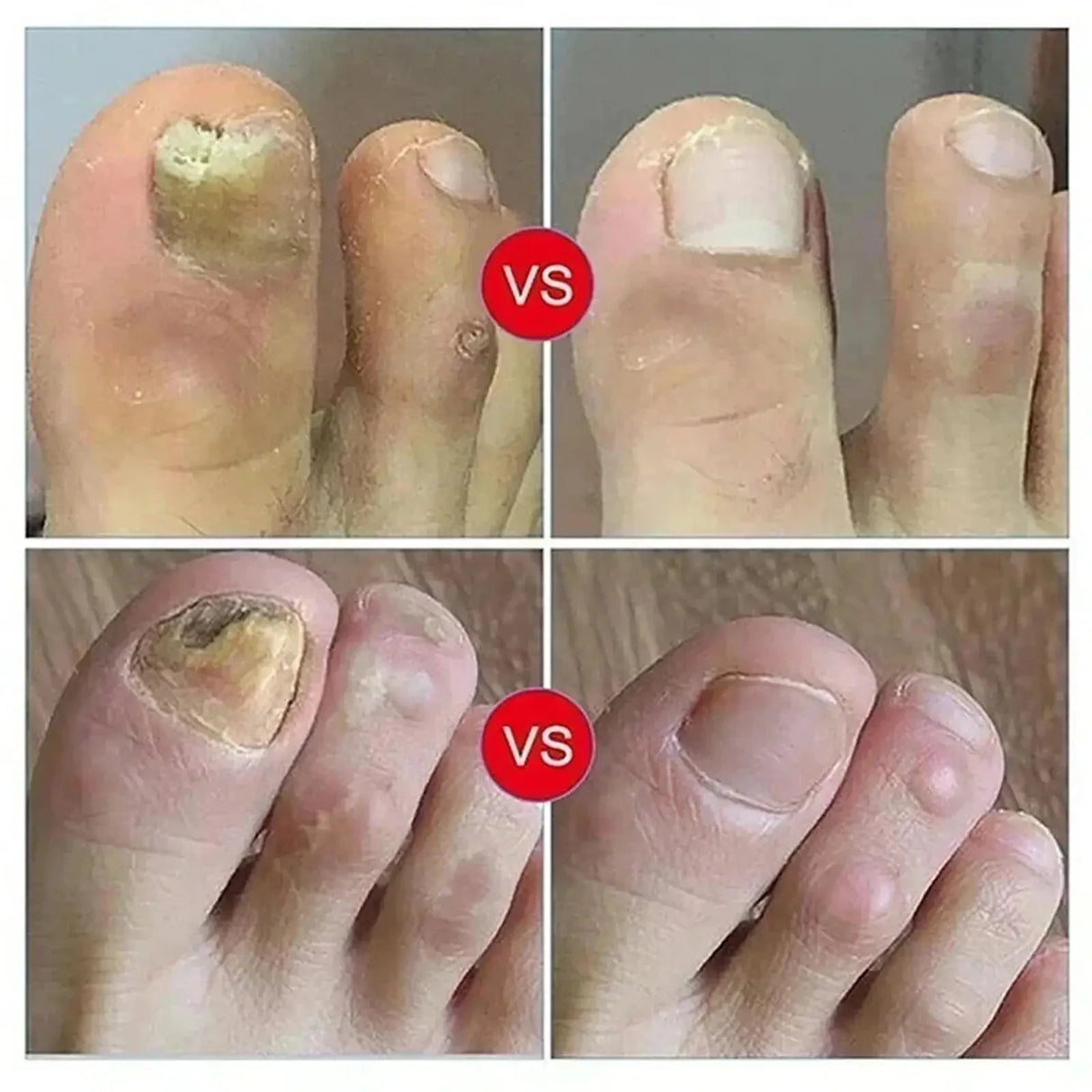 7 Days Nail Fungus Treatment Serum Ginger Anti-infective Paronychia Onychomycosis Toe Foot Nail Fungal Repair Gel Hand Foot Care