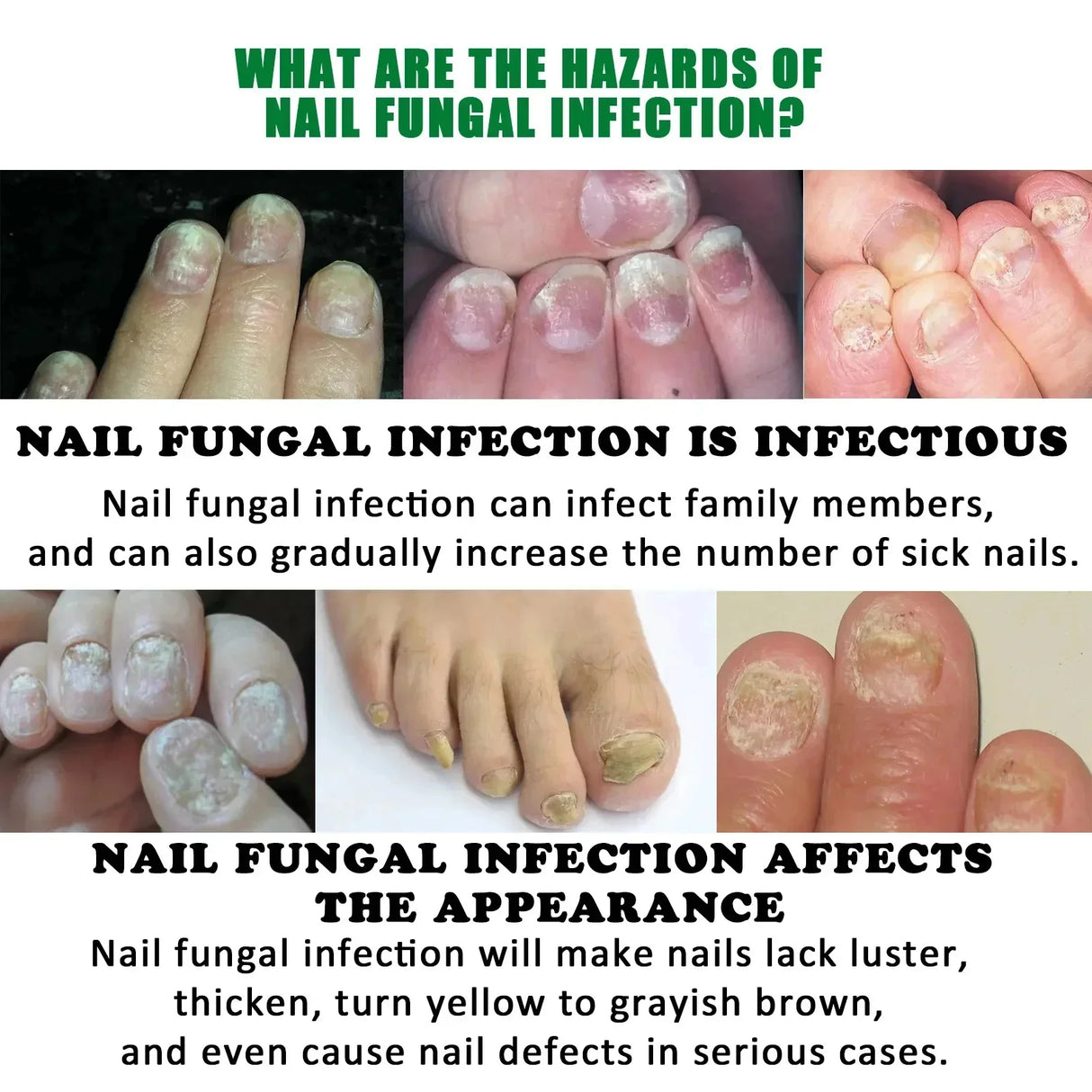 7 Days Nail Fungus Treatment Serum Ginger Anti-infective Paronychia Onychomycosis Toe Foot Nail Fungal Repair Gel Hand Foot Care