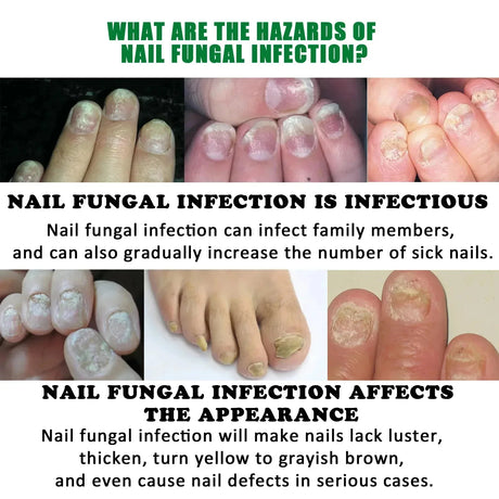 7 Days Nail Fungus Treatment Serum Ginger Anti-infective Paronychia Onychomycosis Toe Foot Nail Fungal Repair Gel Hand Foot Care
