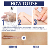 EELHOE Silicone Skin Scar Gel Retinol Niacinamide Scars Stretch Marks Burn Marks Deeply Nourish Skin Reduce Redness Swelling 30g