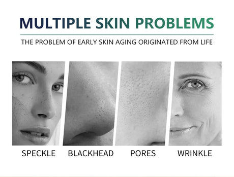 High Quality 50% Chemical Peel Acid Skin Superforce Pigmentation Lightening Melanin Acne Treatment Remove Scar