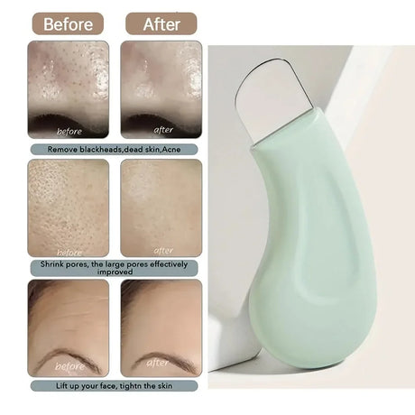 1 Piece Of Manual Blackhead Scraper, Blackhead Remover, Facial Beauty Tool For Removing Acne And Dead Skin