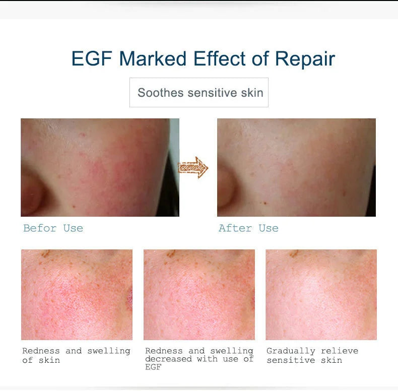 Buy 3 Get 1 Gift ARTISCARE EGF Serum Acne Treatment Blackhead Skin Care Anti Wrinkle Whitening Moisturizing Repair Face Essence