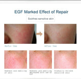 Buy 3 Get 1 Gift ARTISCARE EGF Serum Acne Treatment Blackhead Skin Care Anti Wrinkle Whitening Moisturizing Repair Face Essence