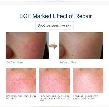 Buy 3 Get 1 Gift ARTISCARE EGF Serum Acne Treatment Blackhead Skin Care Anti Wrinkle Whitening Moisturizing Repair Face Essence