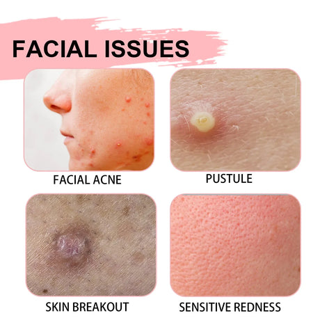 Salicylic Acid Facial Moisturizing Lotion Shrink Pores Nourishing Damaged Skin Treatment Acne Remove Spot Whitening Face Essence