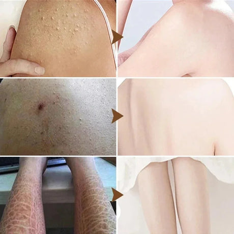 Keratosis Pilaris Repair Treatment Cream Exfoliating Removal Chicken Skin Cleaning Acne Spots Moisturizing Smooth Body Skin Care
