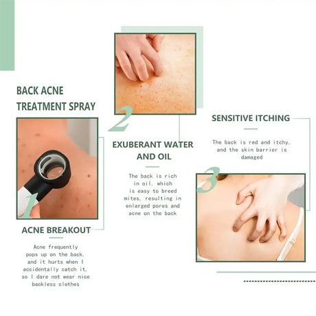 Keratosis Pilaris Repair Treatment Cream Exfoliating Removal Chicken Skin Cleaning Acne Spots Moisturizing Smooth Body Skin Care