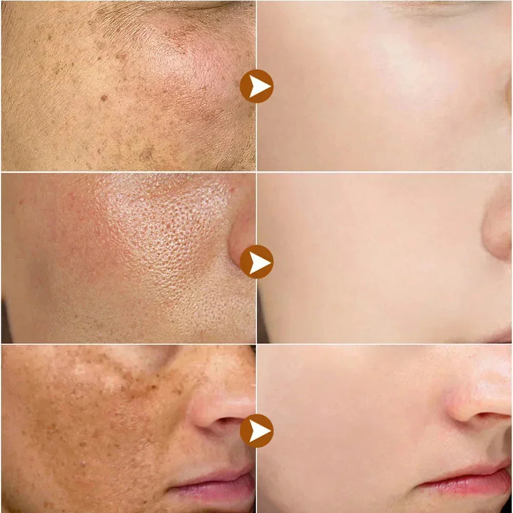 Dark Spots Remover Whitening Face Set Freckle Melanin Correcting Reduce Fine Lines Brighten Essence Korean Beauty Skin Care ﻿