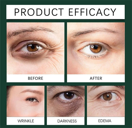 Remove Eye Fat Particles Serum Milia Treatment Products Anti Puffiness Anti Inflammatory Repair Skin Barrier Korean Skin Care