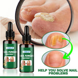 7 Days Nail Fungus Treatment Serum Ginger Anti-infective Paronychia Onychomycosis Toe Foot Nail Fungal Repair Gel Hand Foot Care