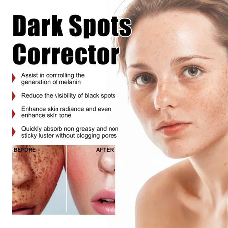 Powerful Spot-Removing Whiten Cream Brighten Skin Fast Eliminates Melanin Pigmentation Melasma Dark Spots Korean Face Skin Care
