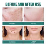 Powerful Spot-removing Whitening Freckles Cream Remove Melasma Dark Spots Fade Pigmentation Acne Moisturizing Brighten Skin Care
