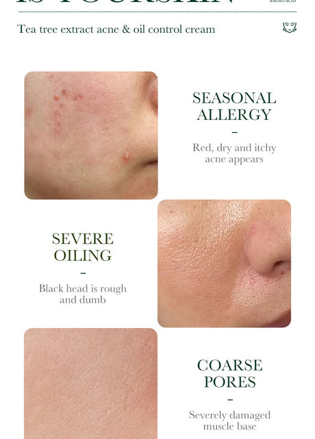 SADOER Tea Tree Acne Removing Face Cream Anti Acne Hydrating Oil Control Moisturizing Facial Creams Face Skin Care Products