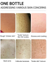Keratosis Pilaris Repair Treatment Cream Exfoliating Removal Chicken Skin Cleaning Acne Spots Moisturizing Smooth Body Skin Care